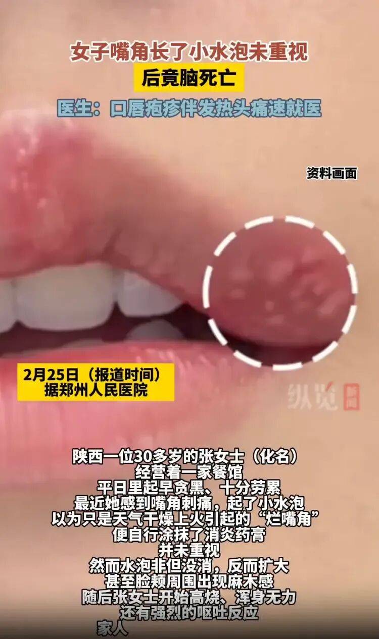 女子嘴角起泡未重视竟导致脑死亡，医生紧急提醒：口唇疱疹伴发热头痛速就医:襄阳市白辗吉服装有限公司十大